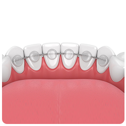 Bonded retainers in Richmond, VA