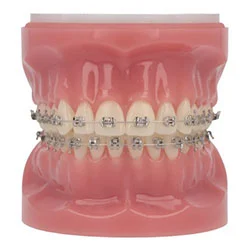 Traditional braces in Richmond, VA